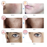 7-Color LED Light Therapy Mask – Wireless Skin Rejuvenation & Acne Treatment Device
